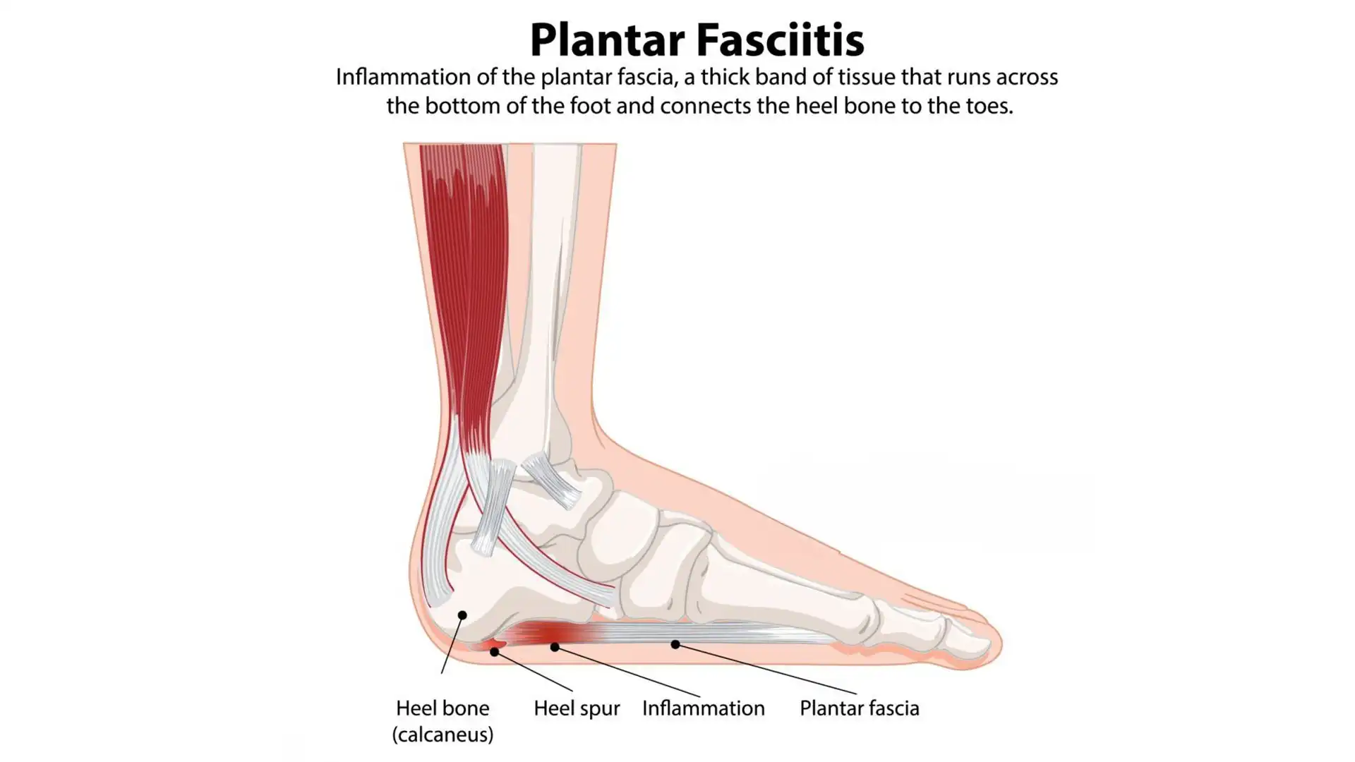 What Type of Foot Massage is Best for Plantar Fascitis